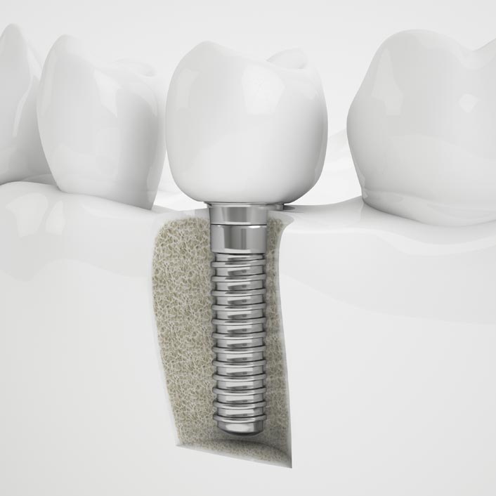 Dental Implants